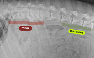 Viêm cột sống